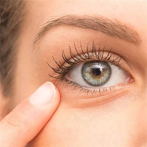Wrinkles around the eyes